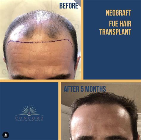 hair restoration los angeles.